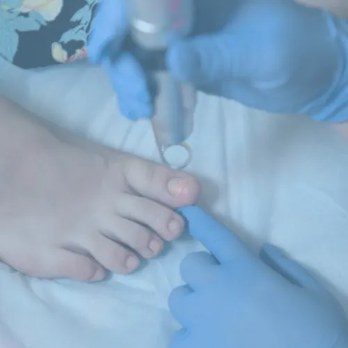 Síntomas comunes de las infecciones por hongos en los pies